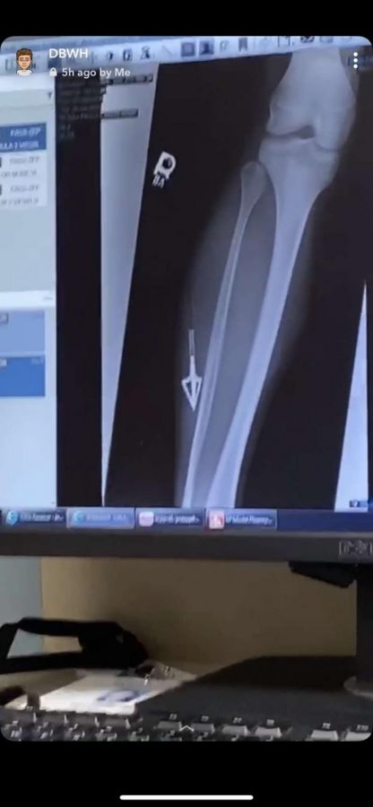 X-RAY VISION. A shot of the X-RAY of junior Colson Schuberts leg shows the arrow near his bone. Schubert injured himself in a hunting accident on Sunday. 